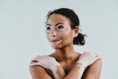 femme qui a du vitiligo