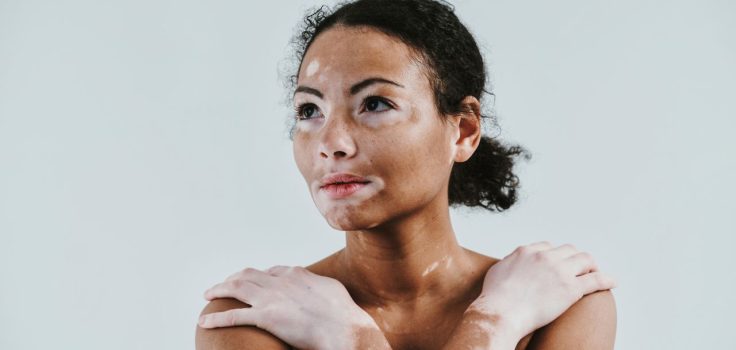 femme qui a du vitiligo