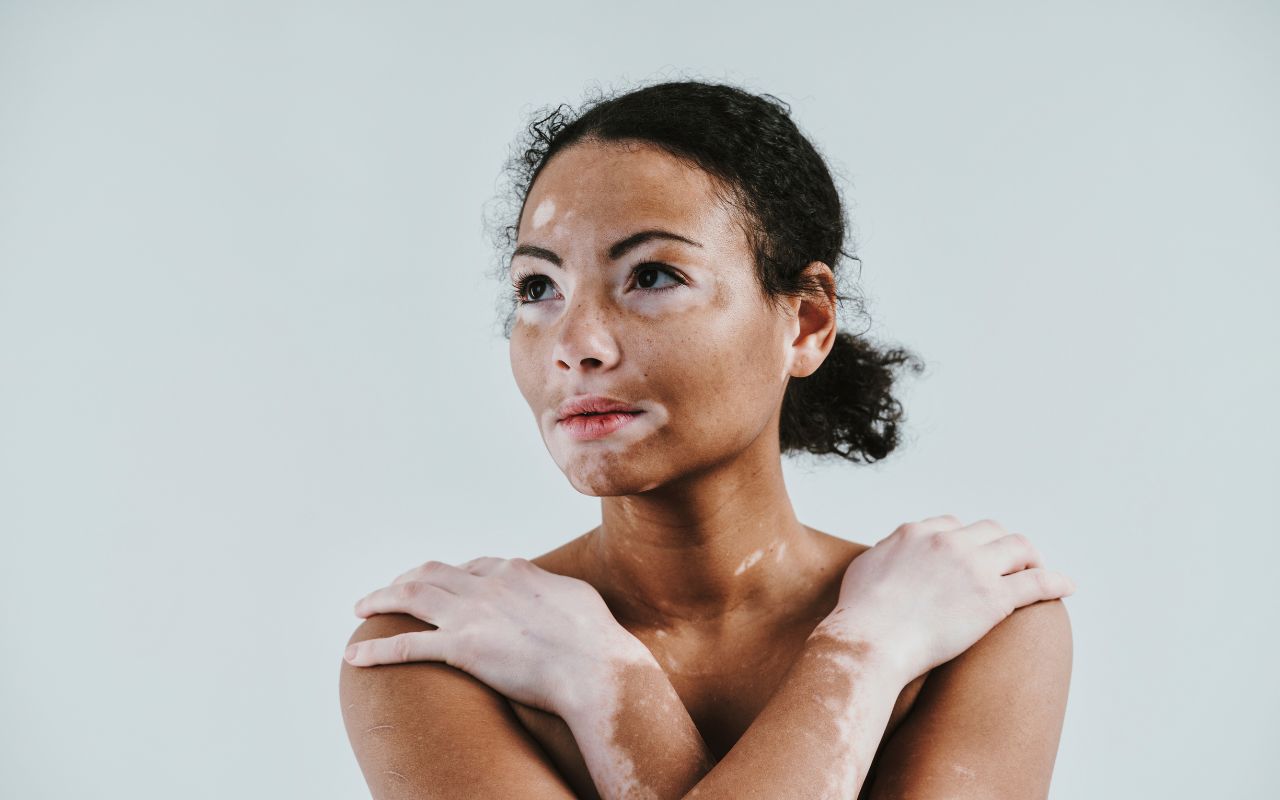 femme qui a du vitiligo